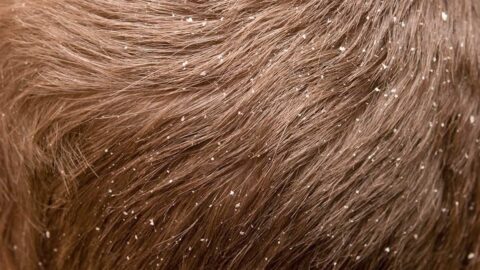 طرق علاج قشرة الشعر