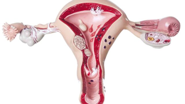 ما هي اعراض انقلاب الرحم وتأثيرة على الحمل وعلاجه