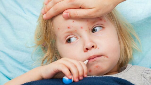 أعراض الجديري المائي عند الأطفال