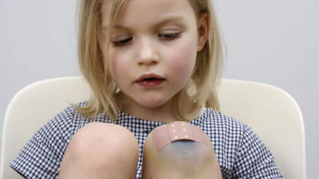 ظهور بقع زرقاء على الجسم عند الأطفال الأسباب والتشخيص والعلاج