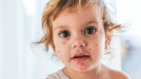 أسباب الطفح الجلدي عند الأطفال