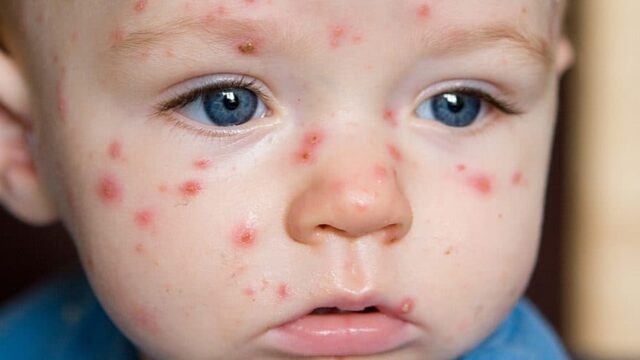 ما هو سبب ظهور حبوب الوجه عند الأطفال والرضع  وعلاجه