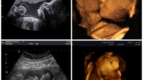 حمل الولد شكل الجنين الذكر فى الشهر الثالث بالسونار