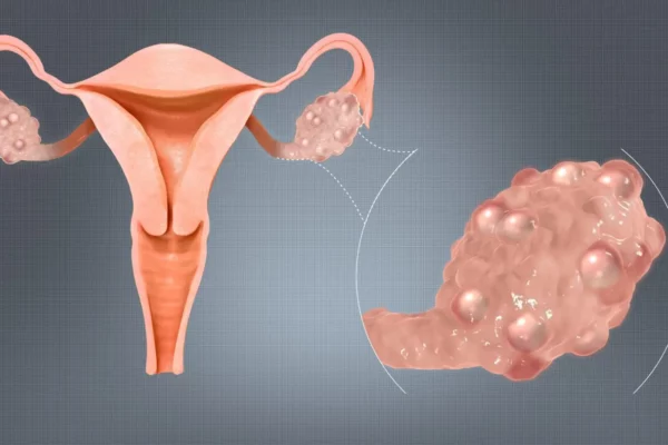 تكيس المبايض الدهني أسبابه ومضاعفاته وعلاجه – تأثيره على الصحة الإنجابية